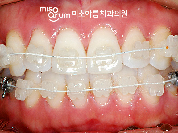 전주교정치과 치아교정 중 주의할 음식 #미소아름치과교정과